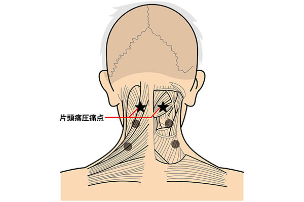 片頭痛は治る 世界的名医が解き明かす痛みの正体と正しい治療法 Think Blog Japan